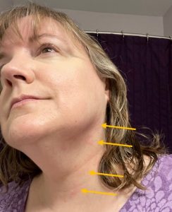Woman with faint red marks on her neck from oil irritation